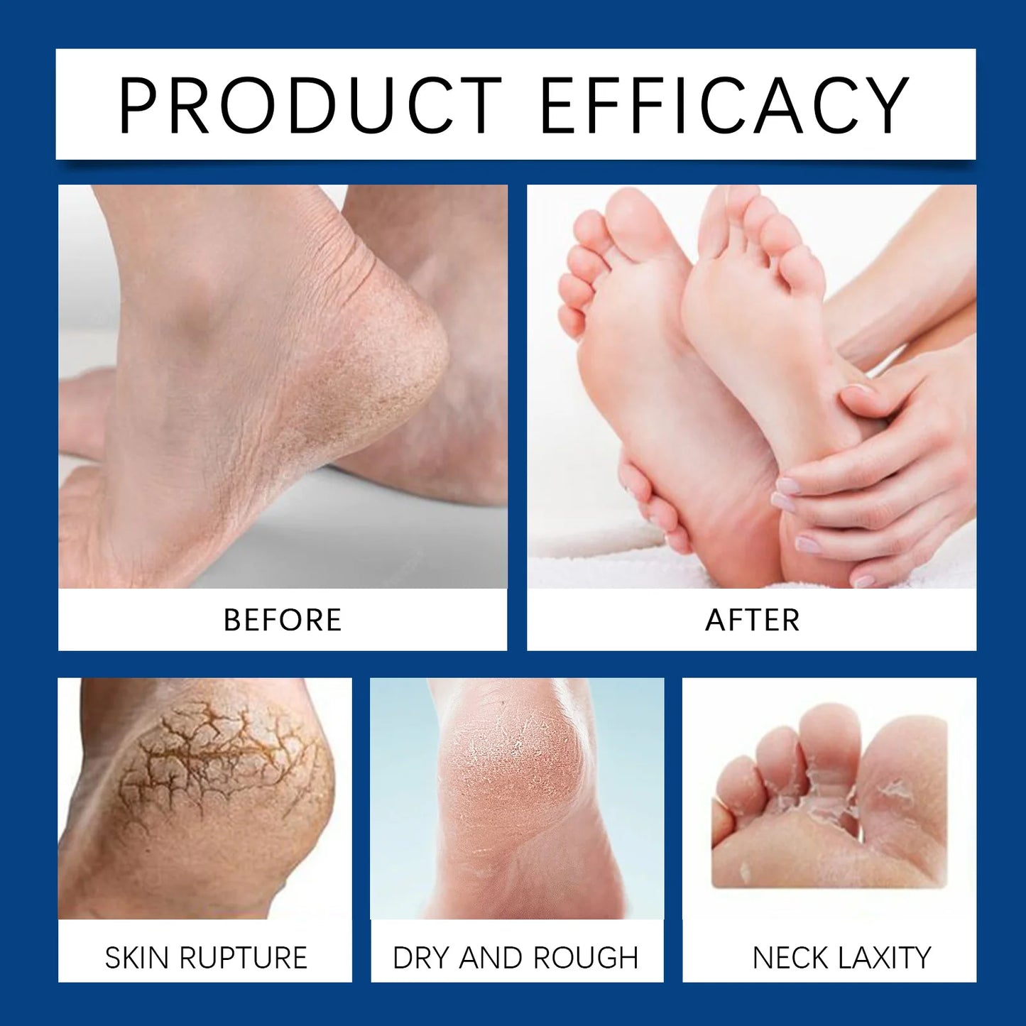 Callus Remover Gel