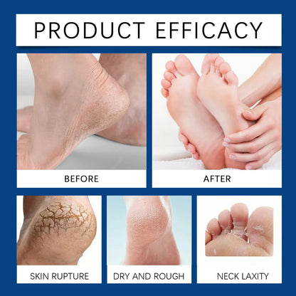Callus Remover Gel